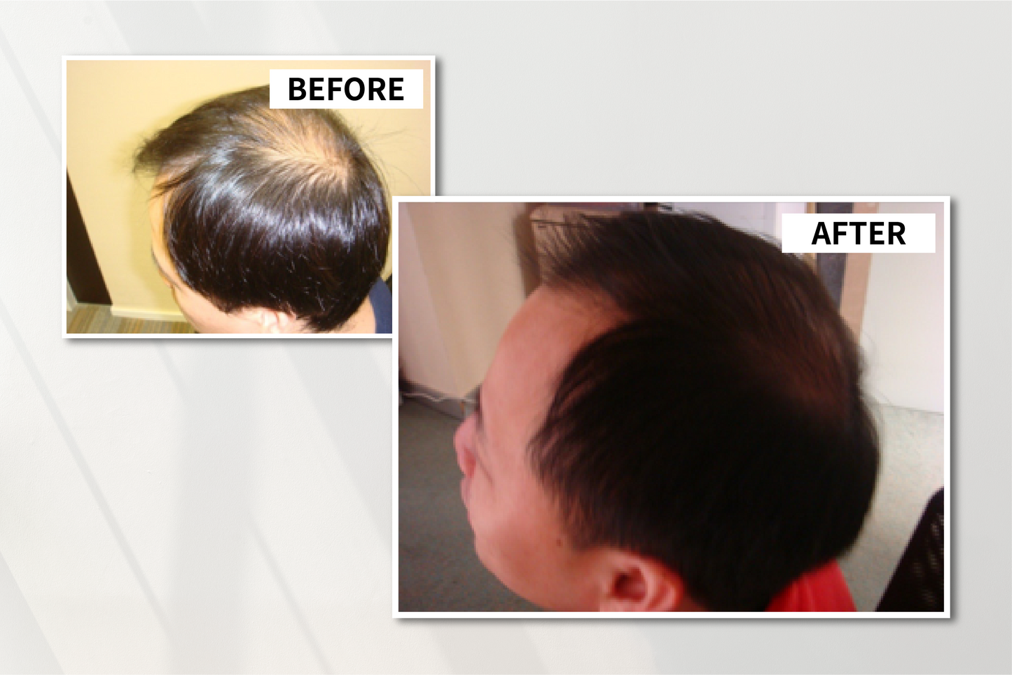 Anti-Hair-Loss Follicle Revitalizing Shampoo